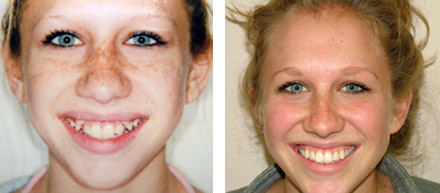 Orthodontics Palatine IL, Before and After